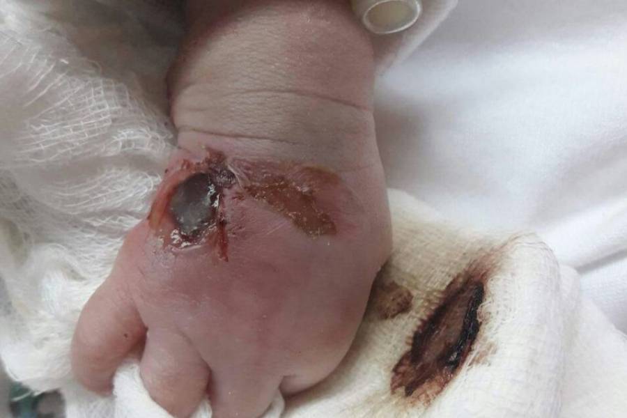 infección de la mano