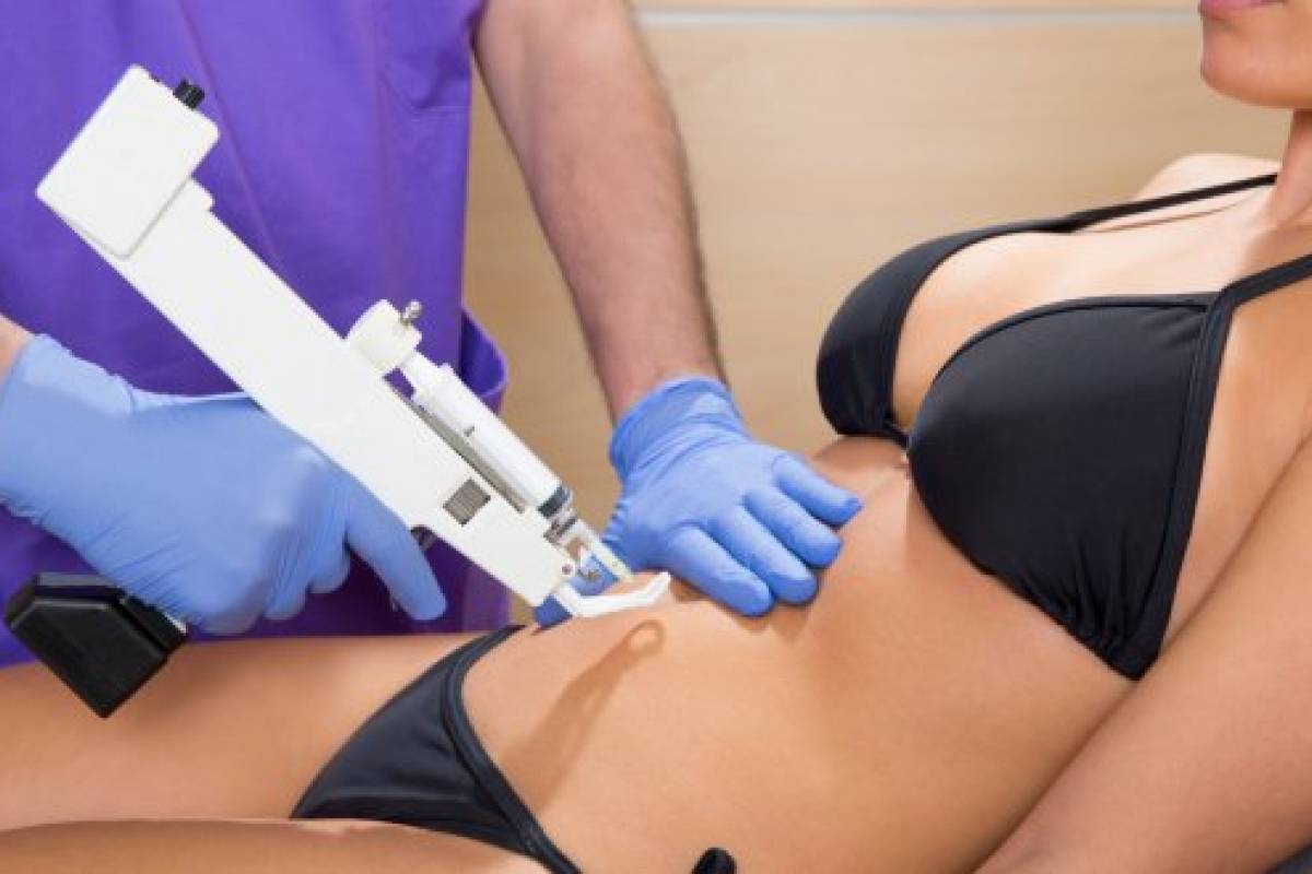 Tratamientos para adelgazar sin cirugia