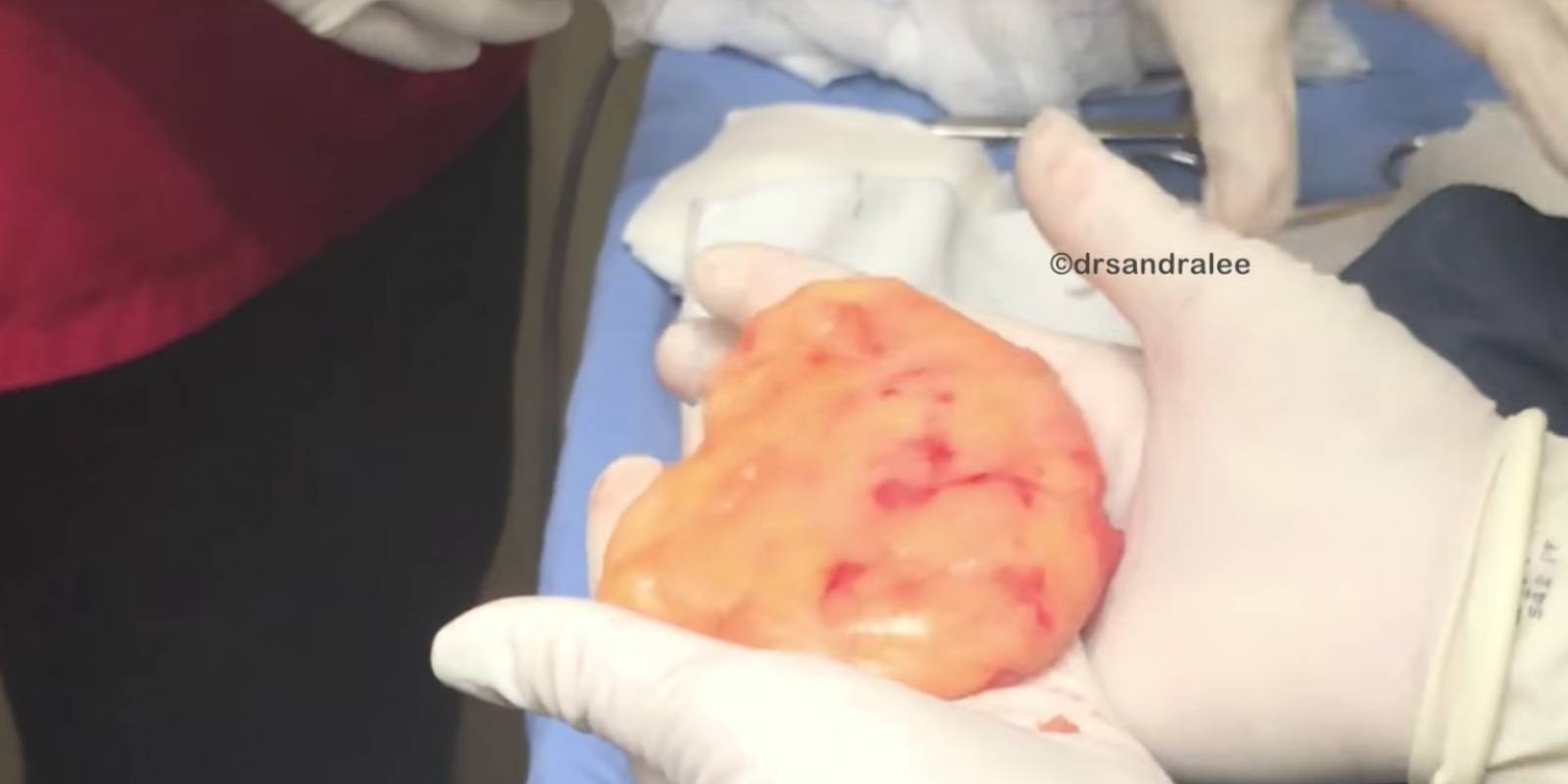 Tumor