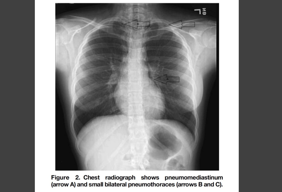 Pulmones