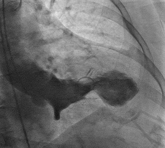 Corazón roto