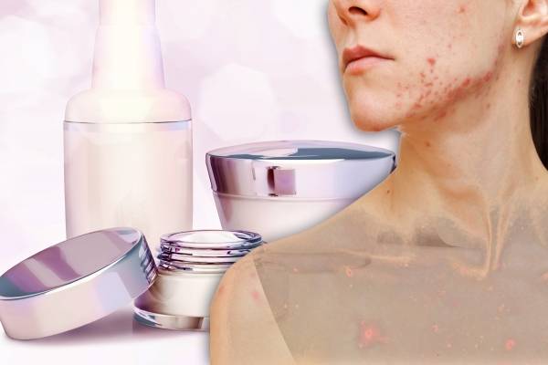 como eliminar las manchas del acne
