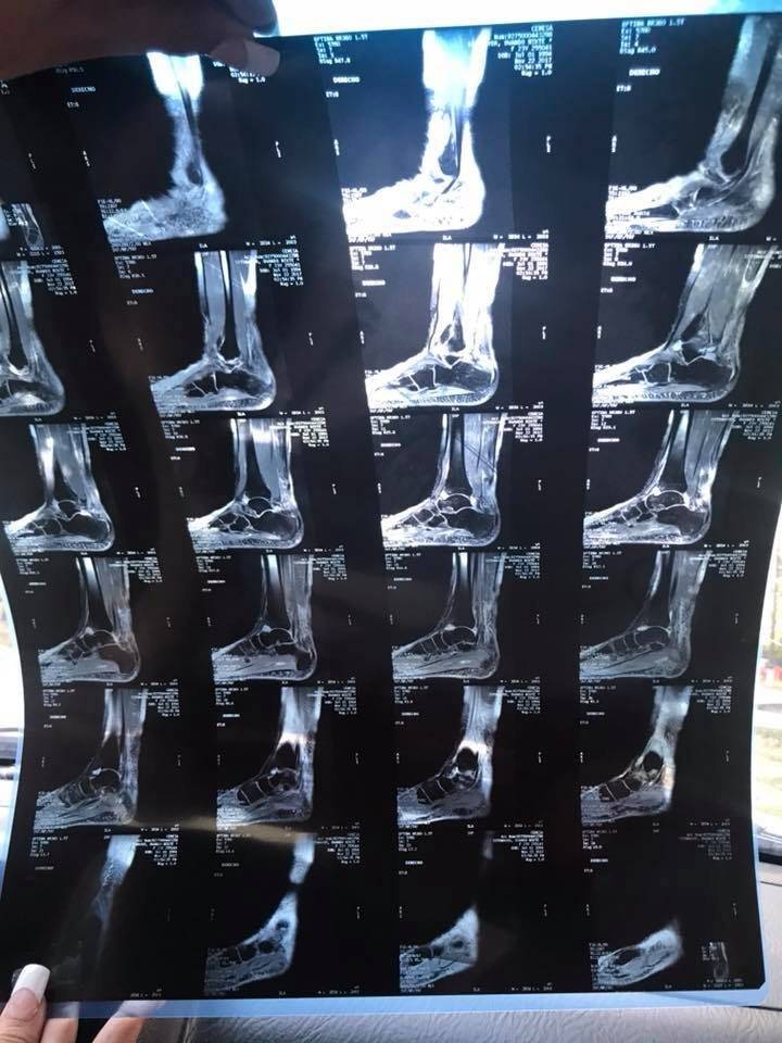 Radiografía de la lesión de Nikté