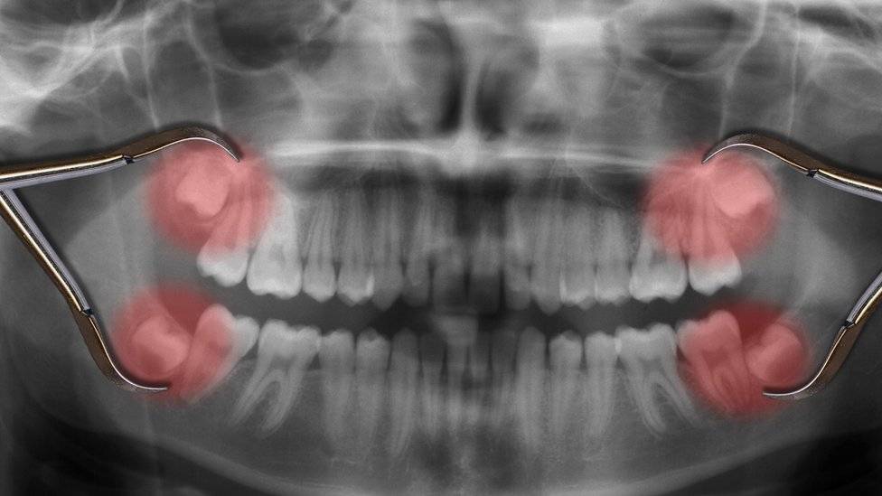 99024610wisdomteeth-2680e633b5a9c07a5b0c4aac004a1c86.jpg