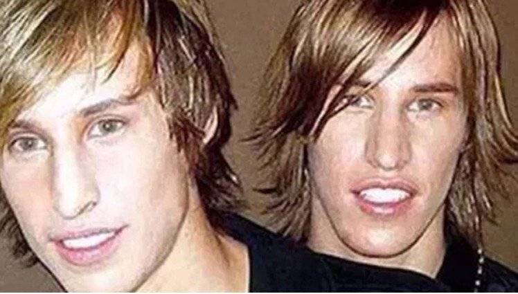 Gemelos se opera para lucir como Brad Pitt