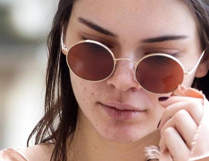 Kendall Jenner acné