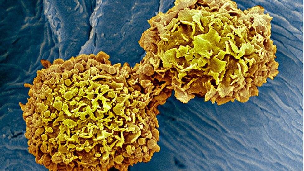 98681534m1220387breastcancercellssemspl-4cdaa0b8842dcb282bb63bd0b9135e02.jpg