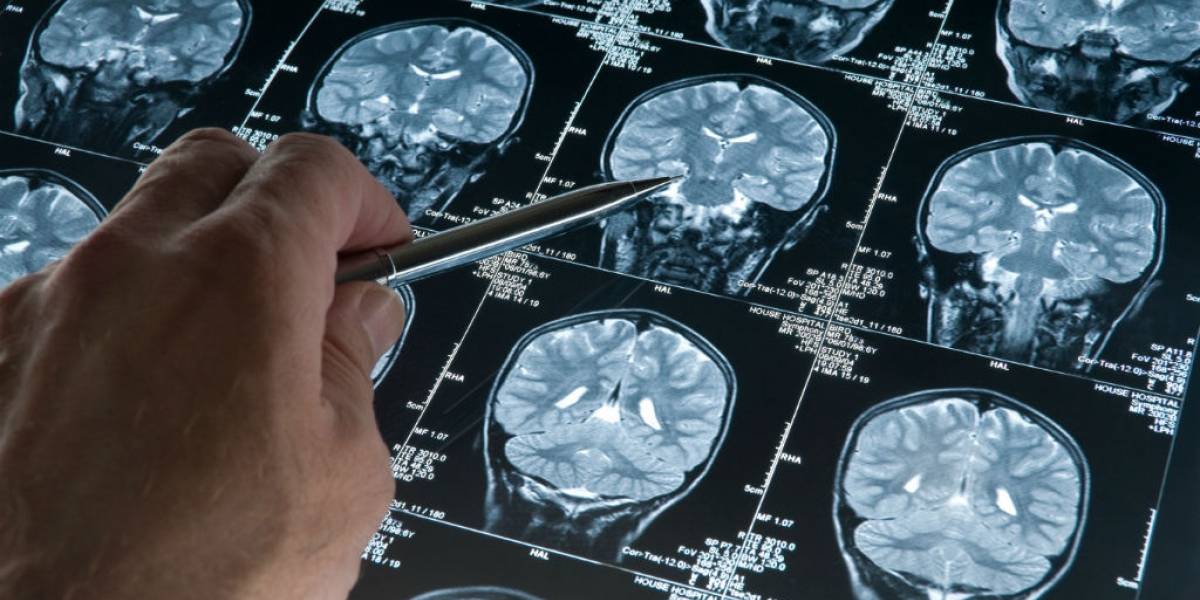 Lucha contra el alzheimer: Terapia experimental reduce proteína que desarrolla la enfermedad