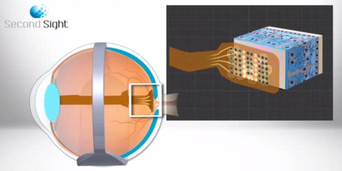 Mujer recupera la vista gracias a una operación de implante de retina