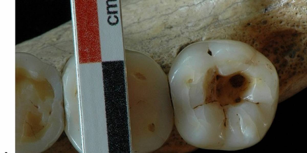La cirugía dental más antigua data de hace 14 mil años