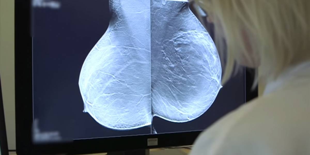 Nuevo método para detectar cáncer de mama sería más efectivo que las mastografías