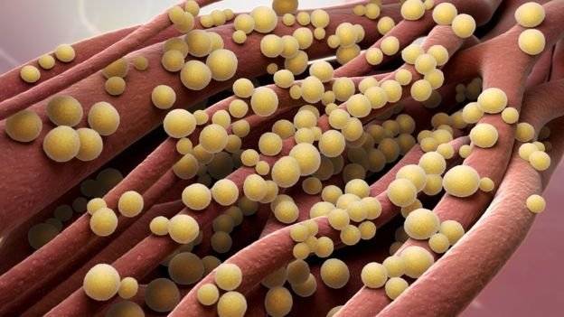 Septicemia
