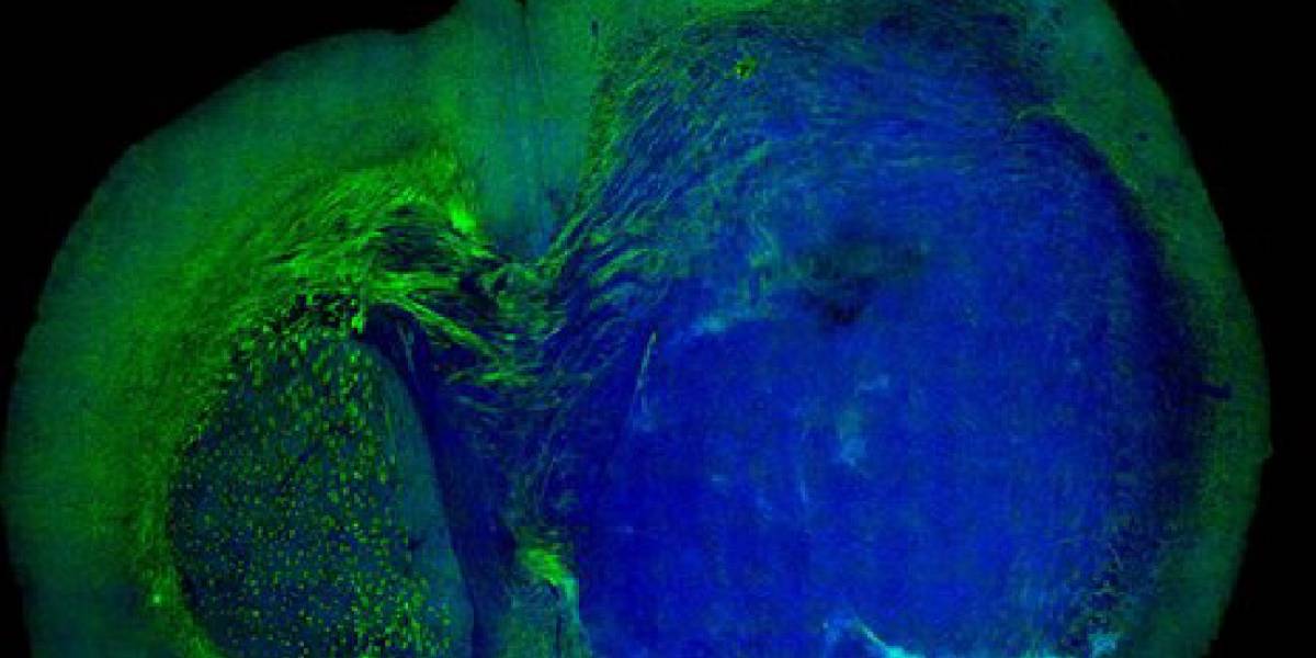 Nueva tecnología láser permite cirugías de tumores cerebrales más seguras