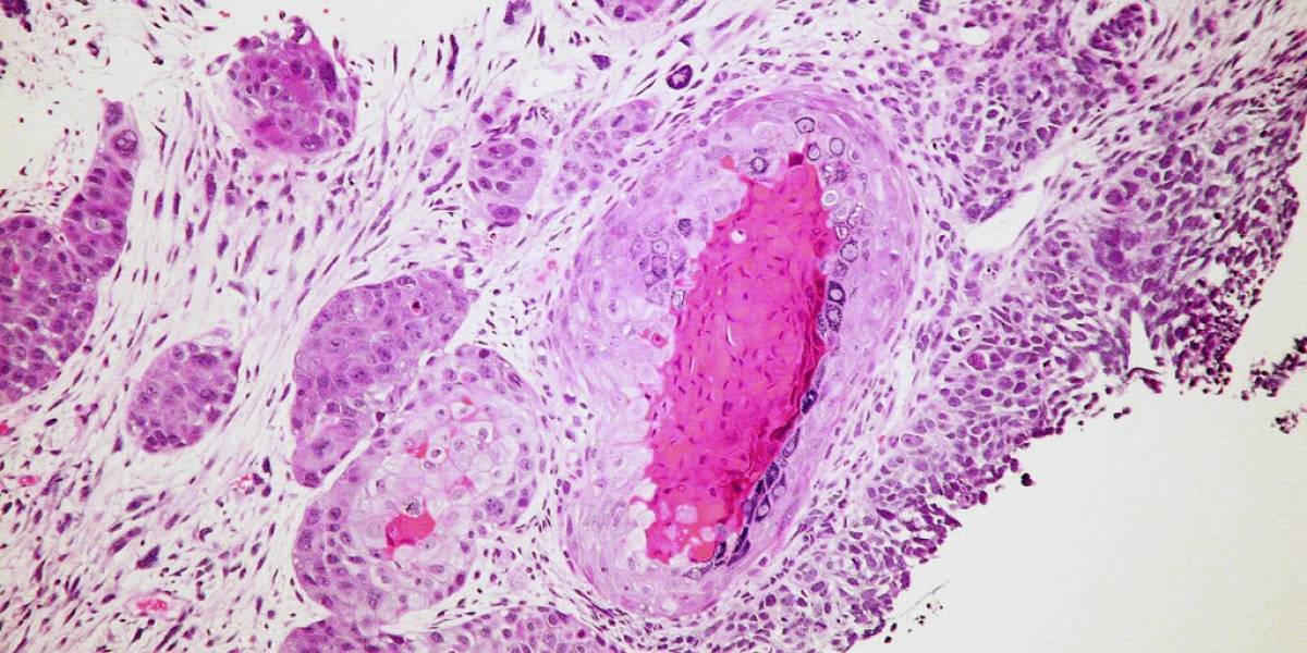 Investigadores desarrollan tratamiento para cualquier tipo de cáncer