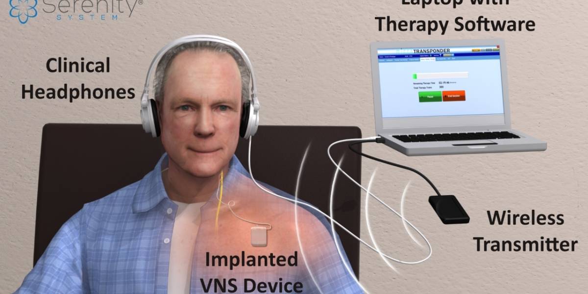 Implante estimula el cerebro a detener los ruidos en los oídos o tinnitus