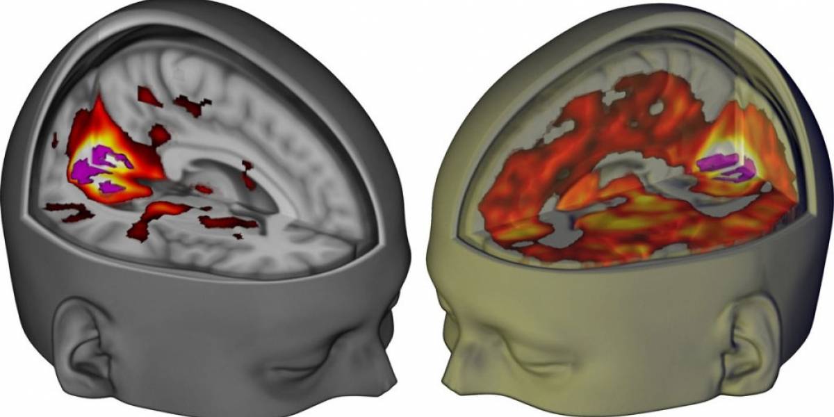 Así luce el cerebro humano bajo los efectos del LSD