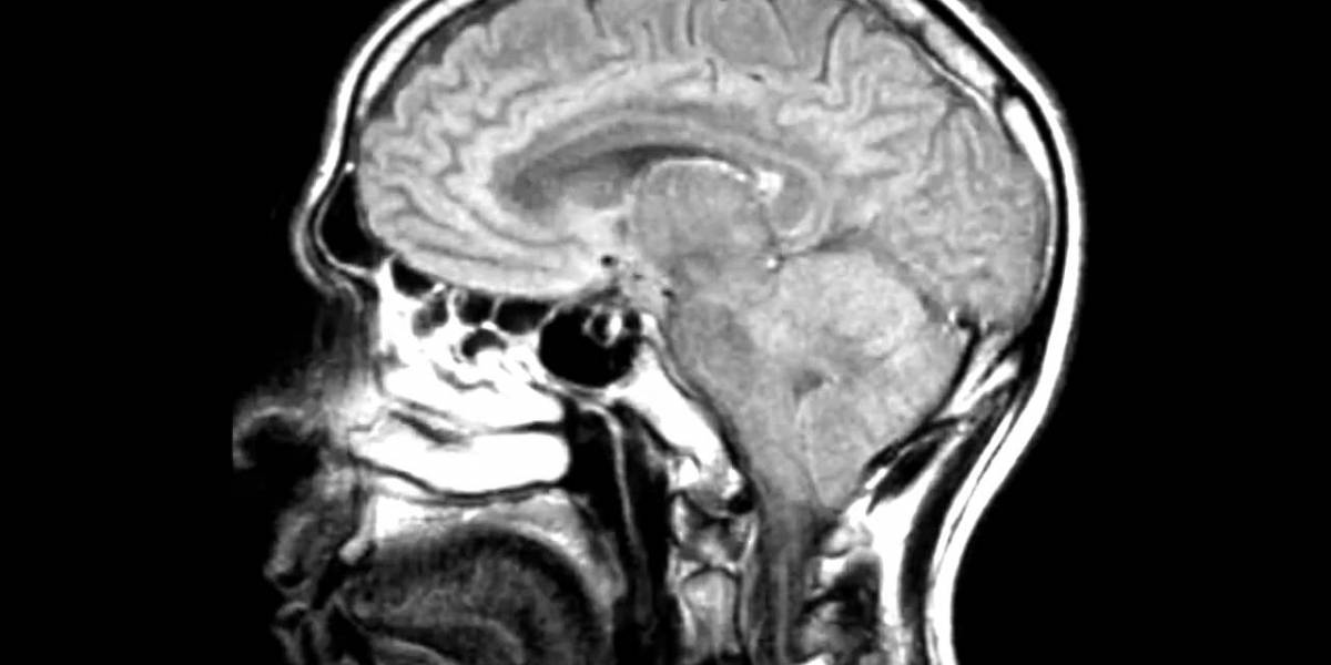 Una nanobala para atacar el cáncer cerebral más mortífero