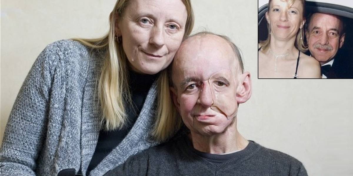 Hombre recupera su rostro gracias a impresoras 3D