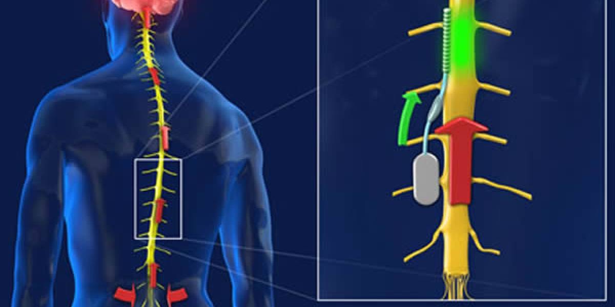 Un chip en la médula espinal suprimirá el dolor crónico