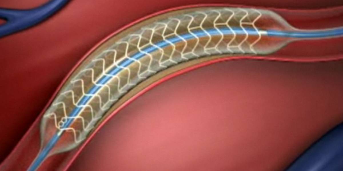Realizan primer implante arterial biodegradable de España