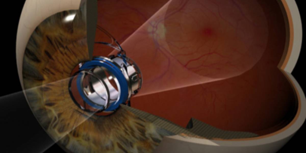 Aprueban en EE.UU. los implantes de "telescopios miniaturas" para ojos