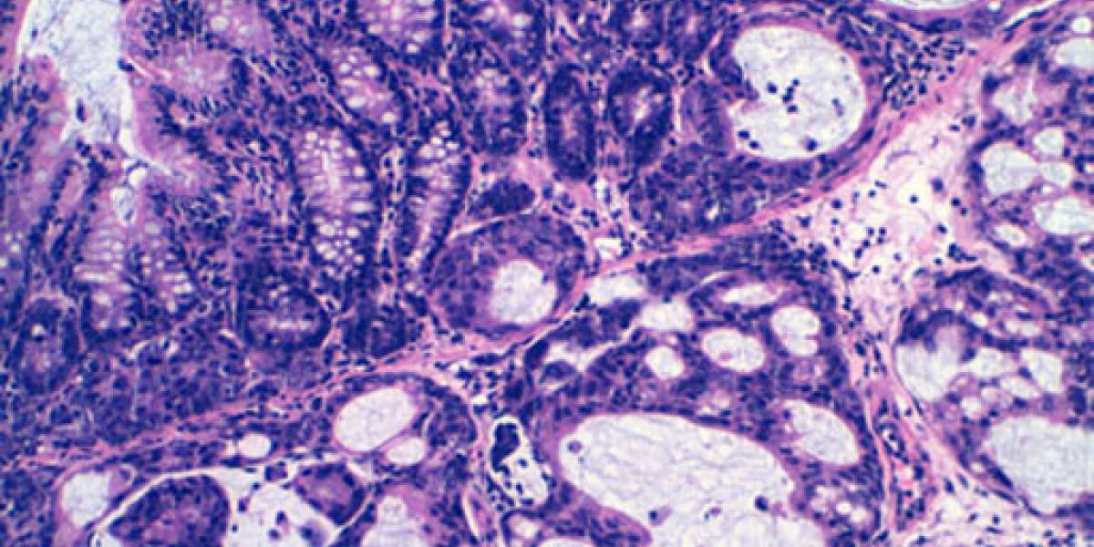 Descubren una sustancia que "frena" el desarrollo del cáncer