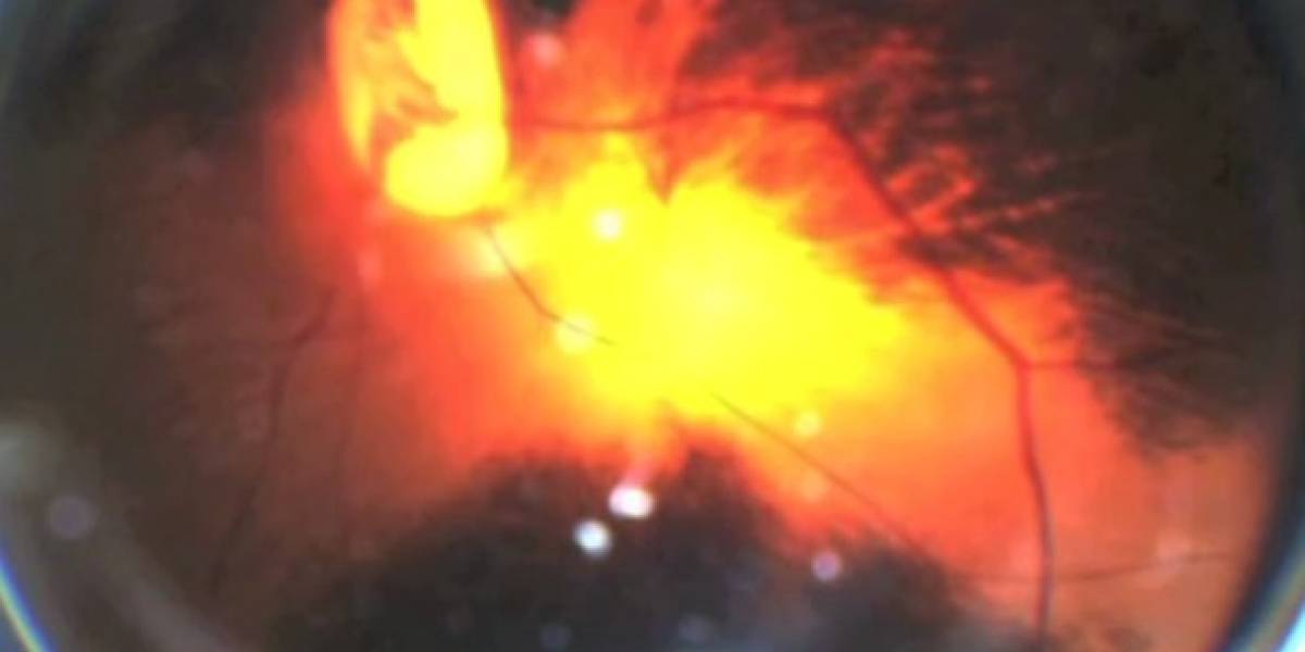 Crean robot que se mantiene en el ojo entregando medicina