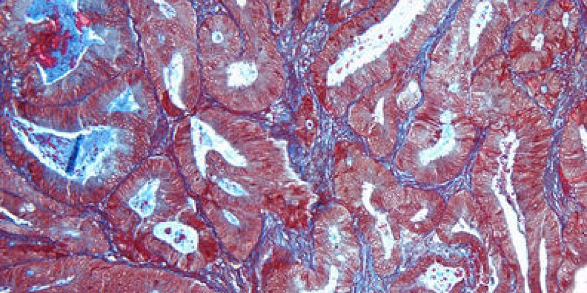 Descubren célula que sabotea al cuerpo en la lucha contra el cáncer