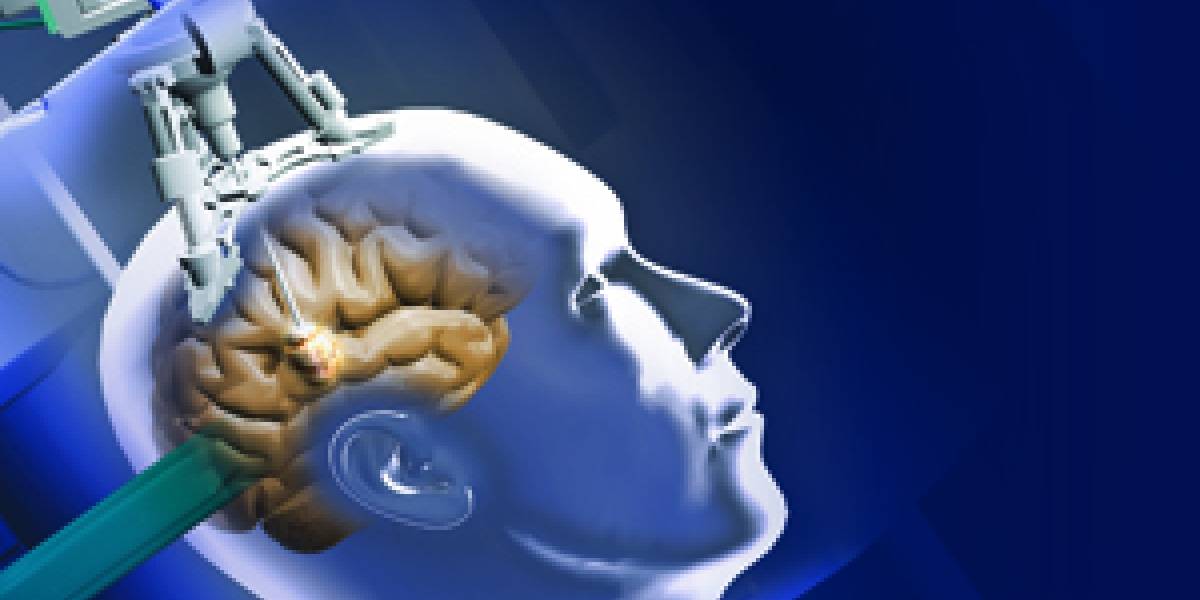 Neurocirujanos crean técnica para quemar tumores cerebrales