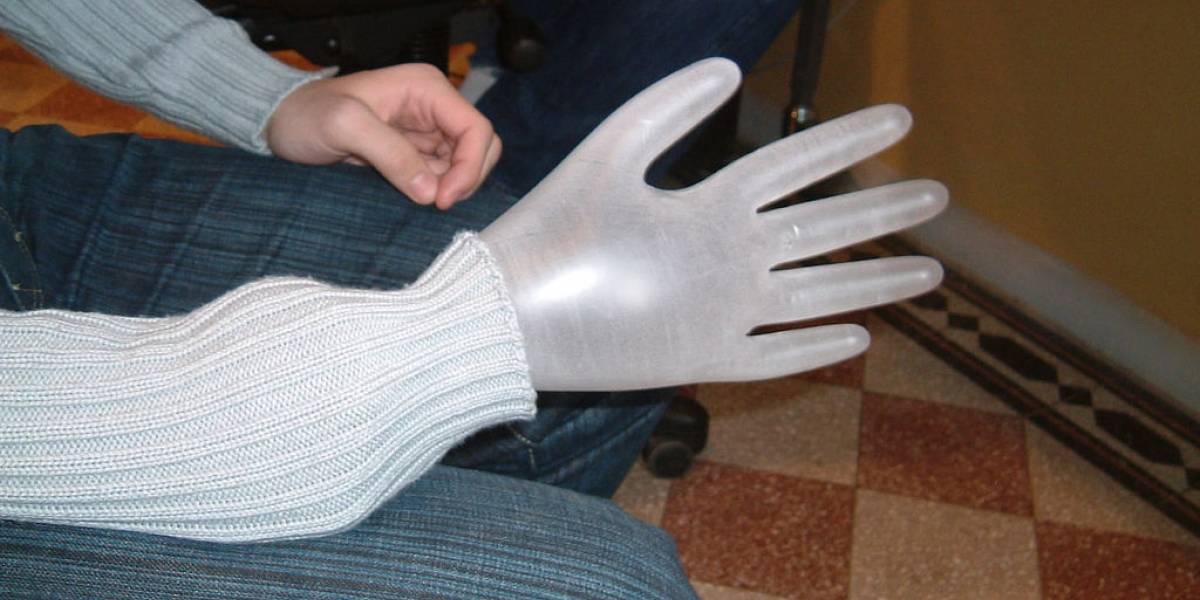 Mujer con síndrome de mano fantasma siente dedos que nunca tuvo