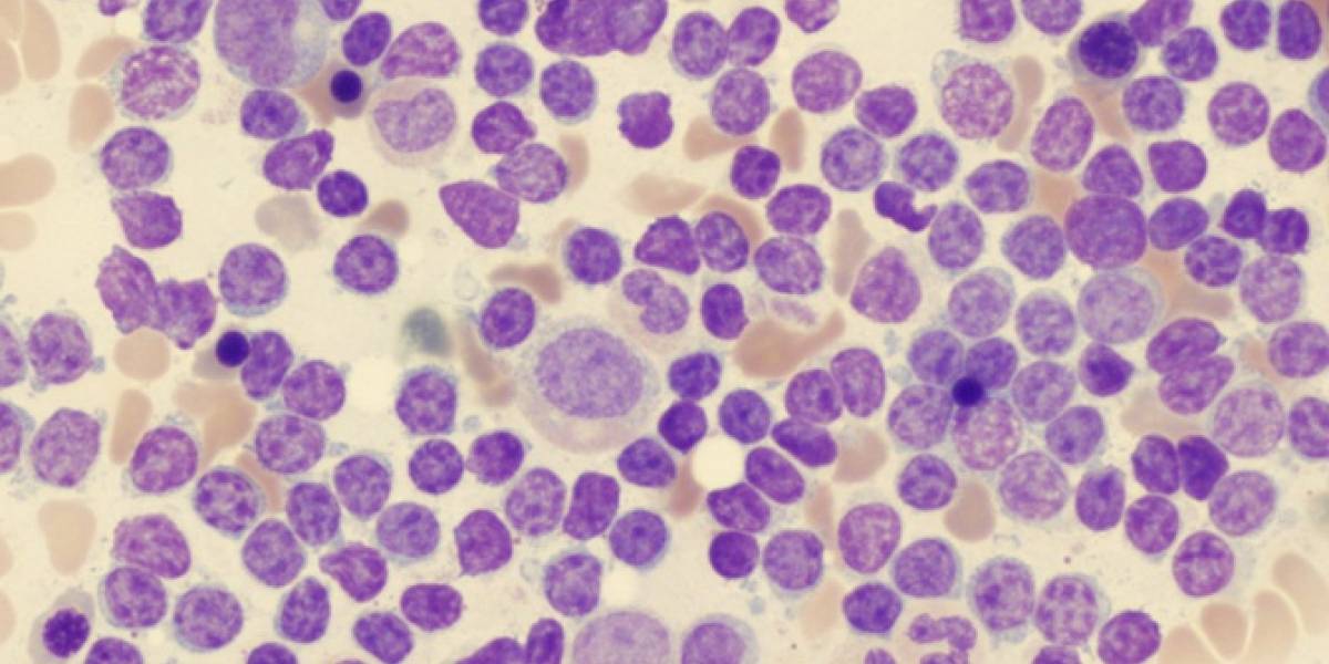 Científicos desarrollaron terapia genética para derrotar la leucemia