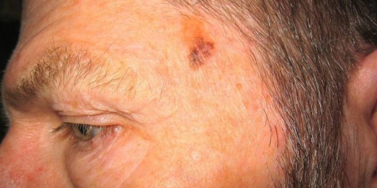 Primeras pruebas revelan que aplicación para detectar melanomas es más certera que los médicos