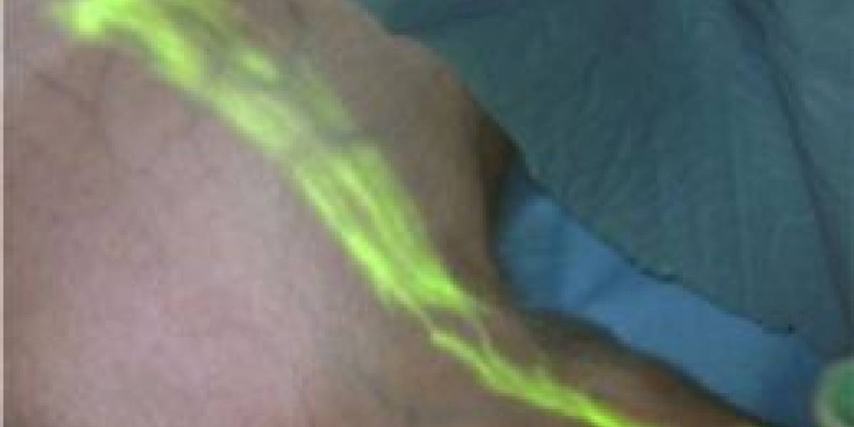Colorean el tejido canceroso para extirparlo