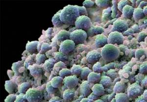 Prueba de ADN para cáncer de próstata Chile