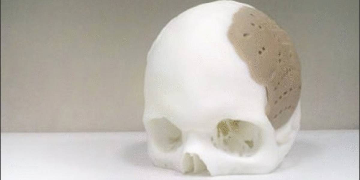 OsteoFab: Implante impreso en 3D permite remplazar el 75% del cráneo de un paciente