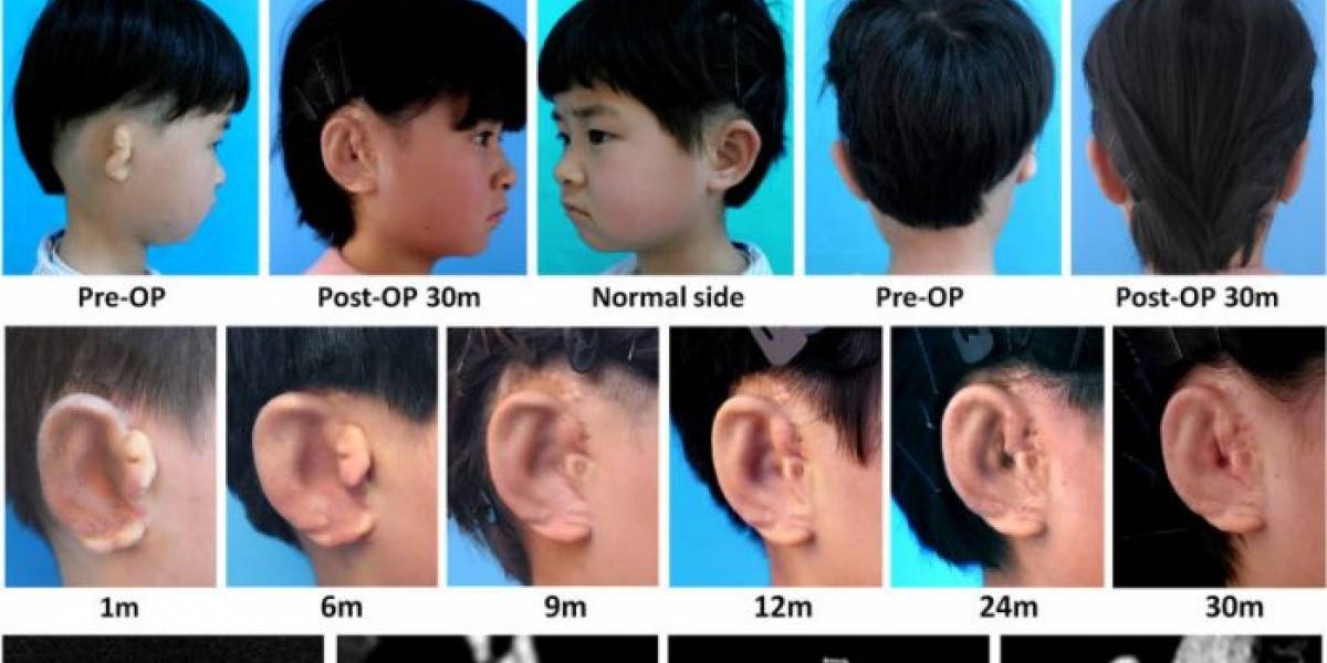 Niños chinos obtienen injertos de orejas hechos con sus propias células