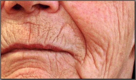 arrugas558x328.jpg