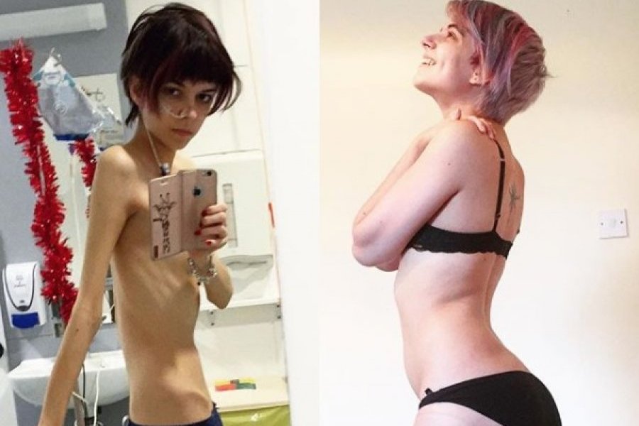 Como bajar de peso anorexia