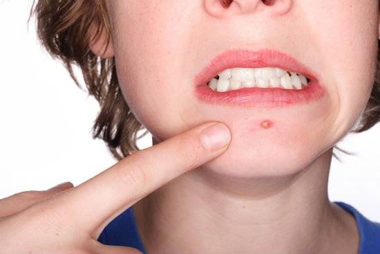 acne1.jpg