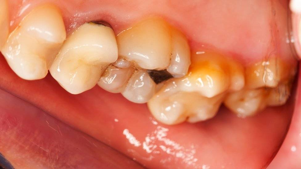 100122158toothdecaygetty-afc4a2c8b9a49d08aaeced6d6e668095.jpg