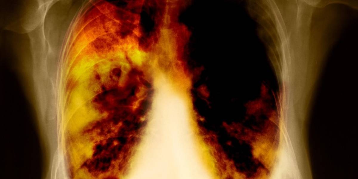 Revolucionaria terapia podría salvarte de morir por cáncer de pulmón