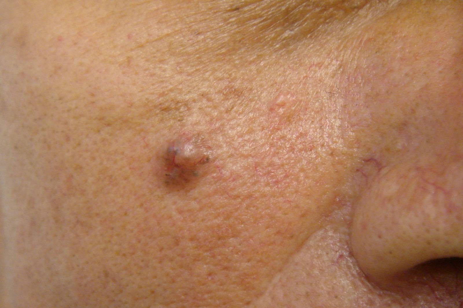 Carcinoma Basocelular Carcinoma Basocelular