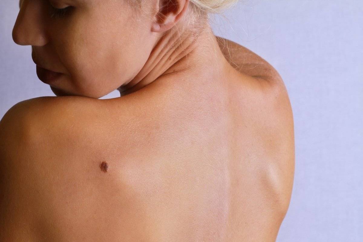 Melanoma