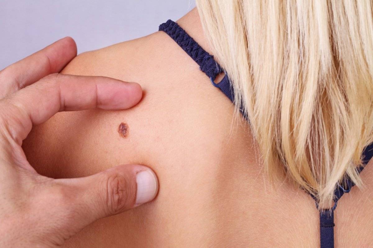 Melanoma