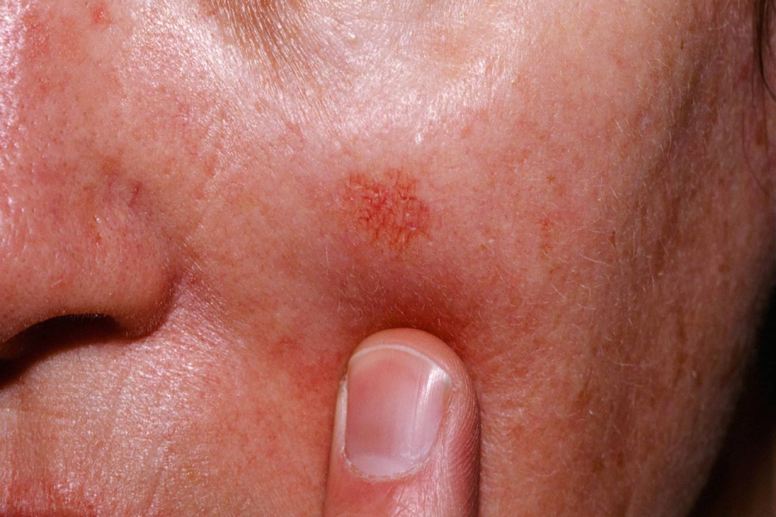 Queratosis actínica Queratosis actínica