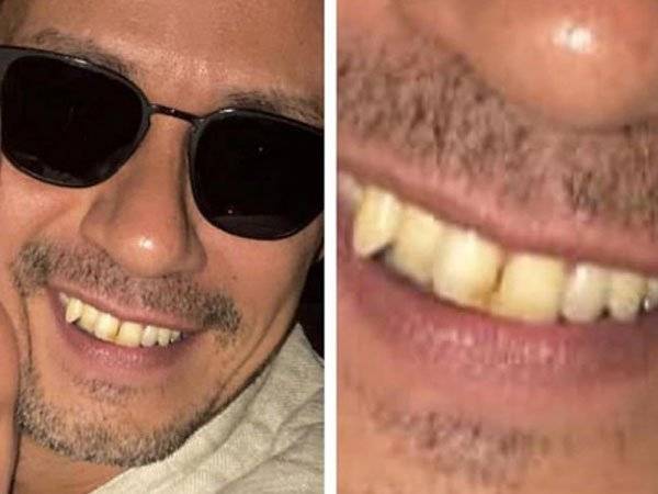 Marc Anthony Redes Sociales Dientes