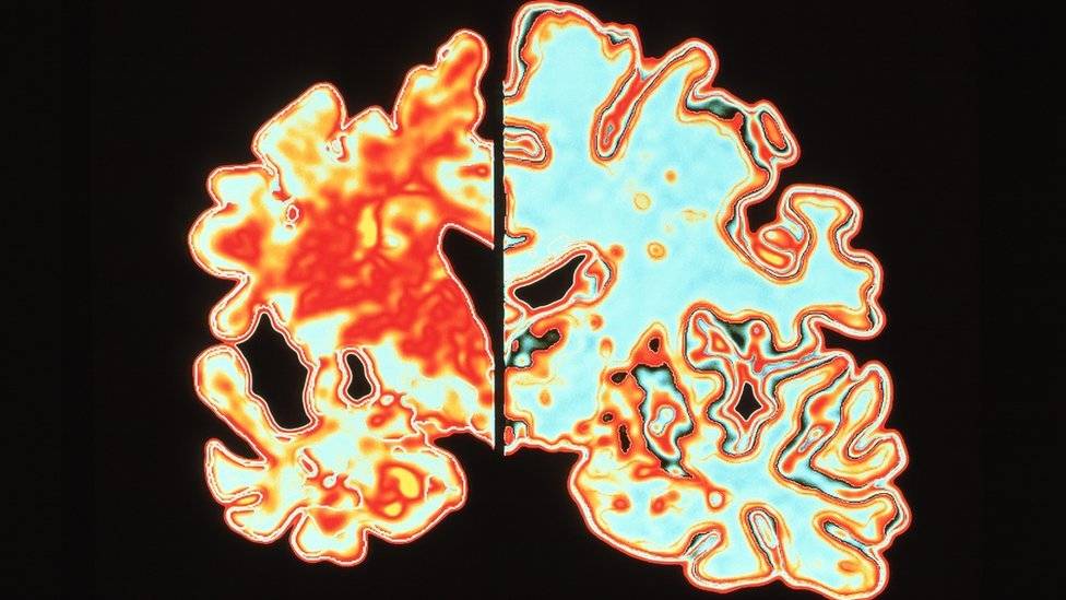 100298810m1080427alzheimersdiseasebrainvsnormalspl-34f8501d8a72c8ba9baeddf49ecf23ce.jpg