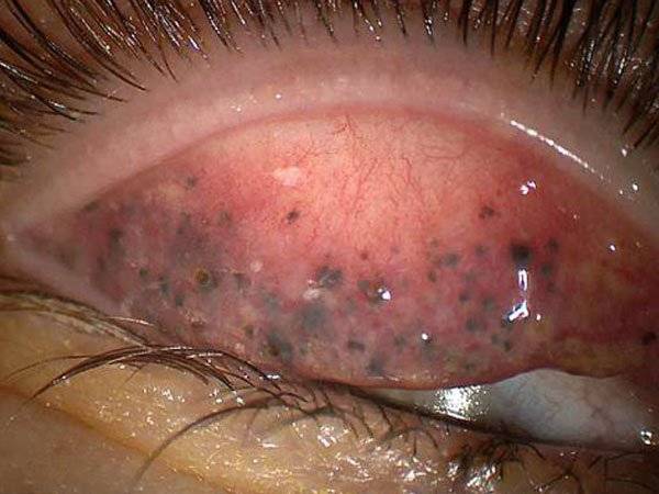 Mujer Ciega Ojos Máscara