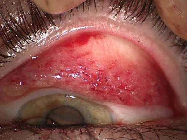 Mujer Ciega Ojos Máscara