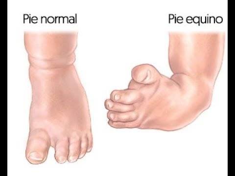 Pie equino varo